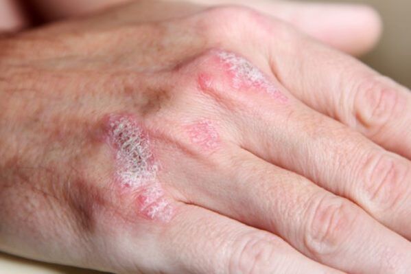 Symptome von Psoriasis an den Händen