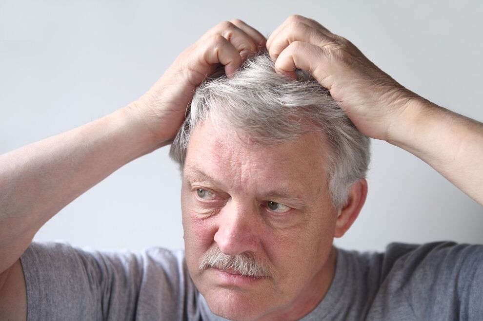Symptome von Psoriasis am Kopf