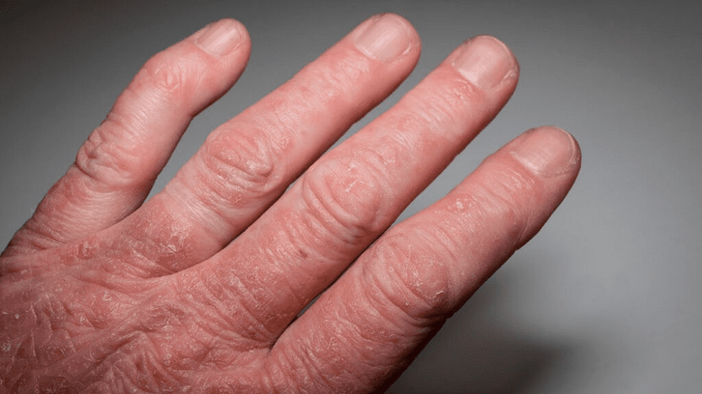 Psoriasis-Arthritis in den Händen