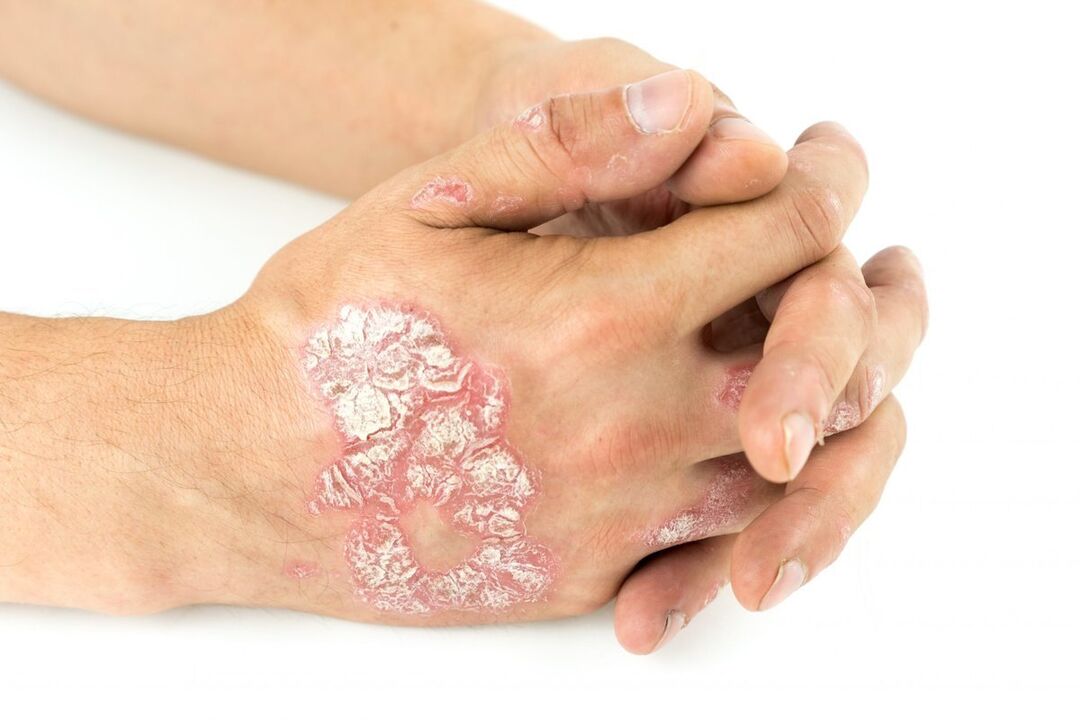 Wie sieht Psoriasis an den Händen aus 