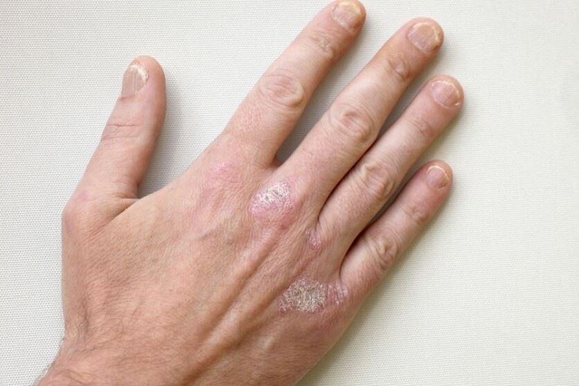Ein obligatorisches Symptom der Psoriasis sind schuppige Plaques auf der Haut. 