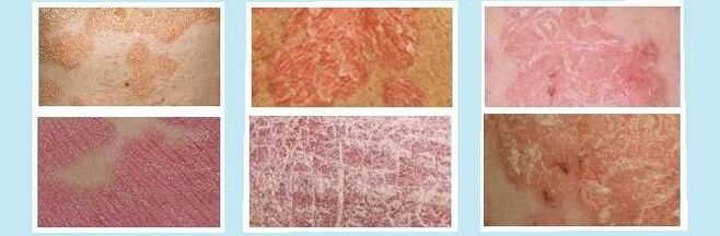 Hautausschläge, die für verschiedene Arten von Psoriasis charakteristisch sind. 