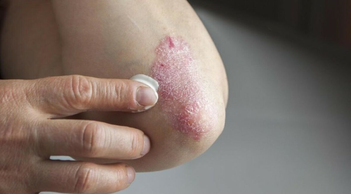 Psoriasis, die die Haut betrifft und deren Behandlung die Verwendung von Salben umfasst. 