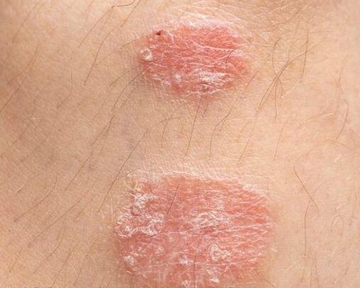 Aussehen von Psoriasis -Platten