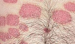 Mehrere Rosenformationen im Bauch