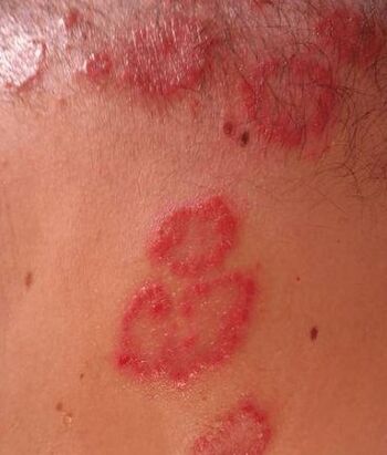 Psoriasis -Spots