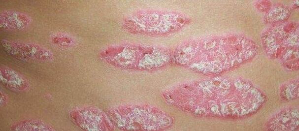 Das progressive Stadium der Psoriasis