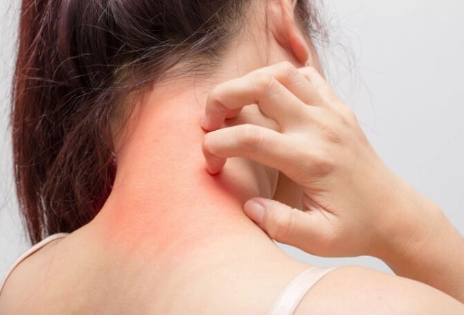 Juckreiz ist eine der Ursachen für Psoriasis