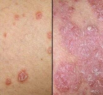 Psoriasis -Platten