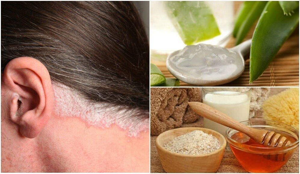 Behandlung von Psoriasis mit beliebten Heilmitteln