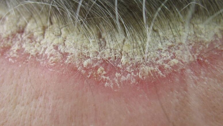 Kopfhaut Psoriasis