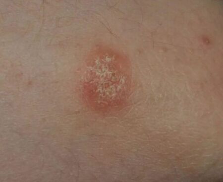 Ort der Psoriasis