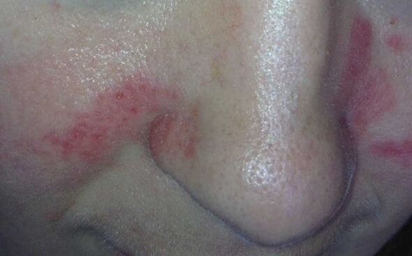 Psoriasis -Symptome im Gesicht