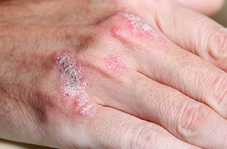 Psoriasis durch Ladomary erhalten