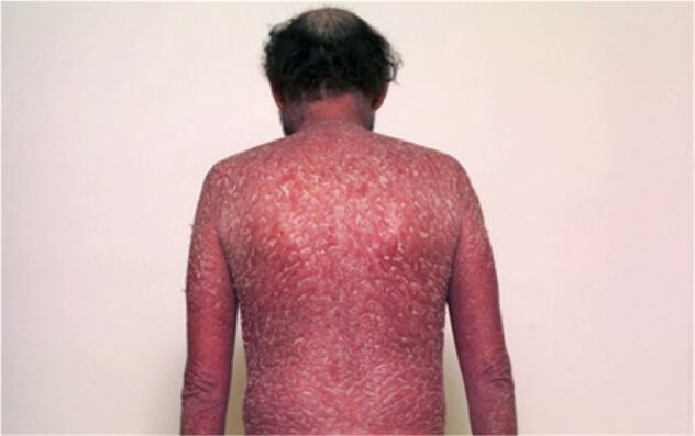 Die dritte Stufe der Psoriasis