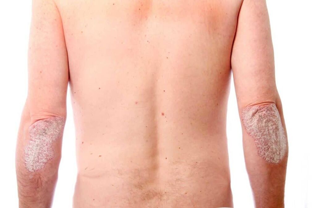 Die zweite Stufe der Psoriasis