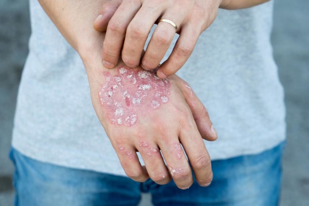 Psoriasis ist