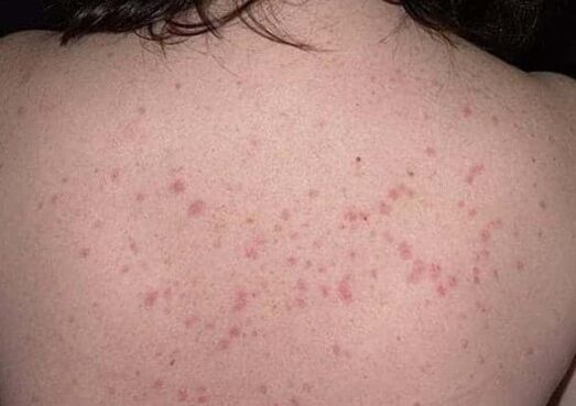 Das Anfangsstadium der Psoriasis