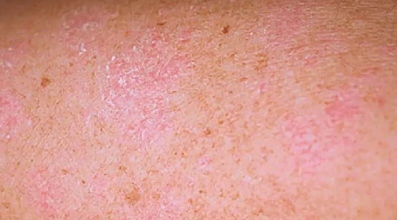 Das regressive Stadium der Psoriasis