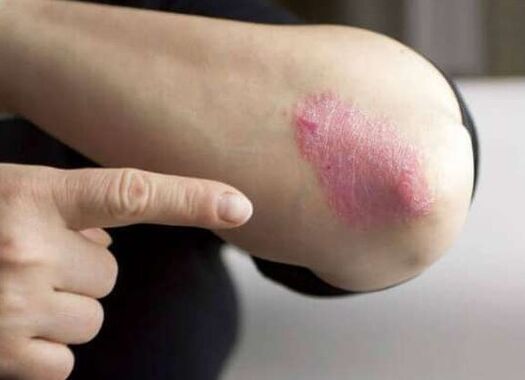 Die stationäre Stufe der Psoriasis