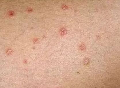 Psoriasis des Anfangsstadiums
