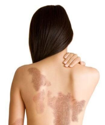 Stadien der Psoriasis abhängig vom Bereich der Läsion