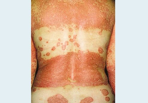 Genitalpsoriasis