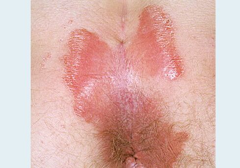 Psoriasis von nahezu Veränderungen