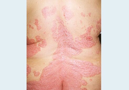 Rückenpsoriasis
