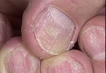 Nagel -Psoriasis
