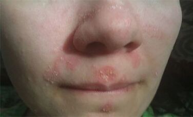 Psoriasis im Gesicht