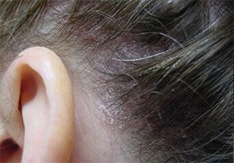 Psoriasis im Kopf