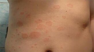 Psoriasis im Magen