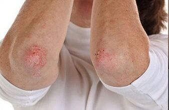 Psoriasis in den Ellbogen