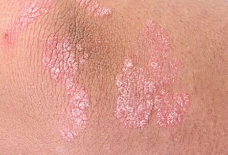 Soriasis