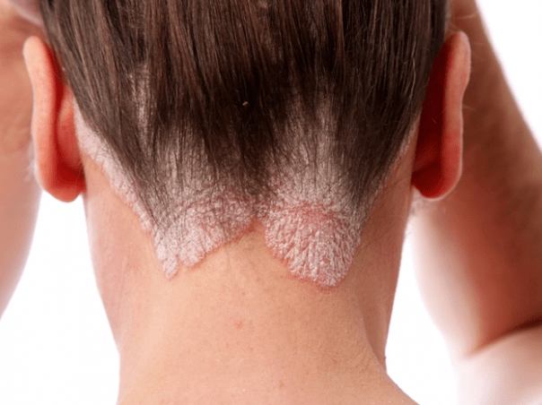 Psoriasis im Kopf