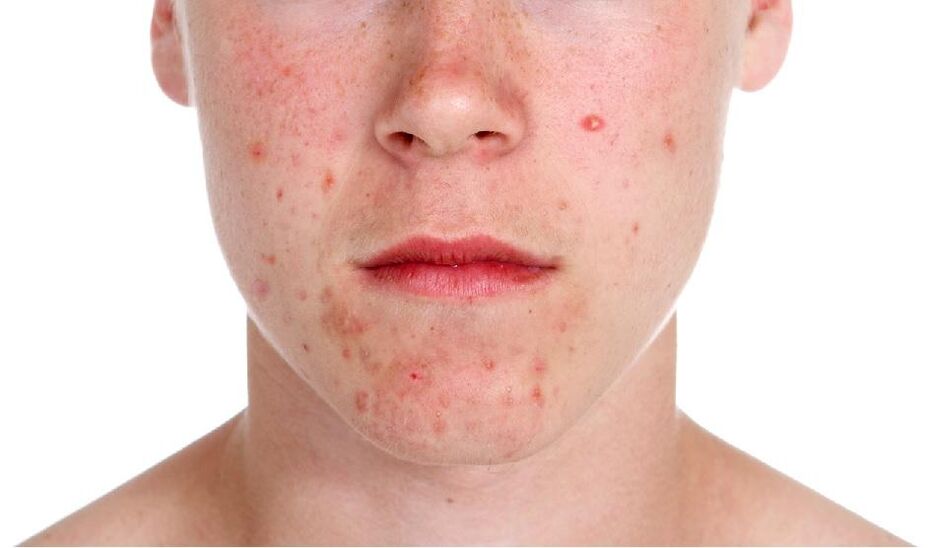 Psoriasis im Gesicht