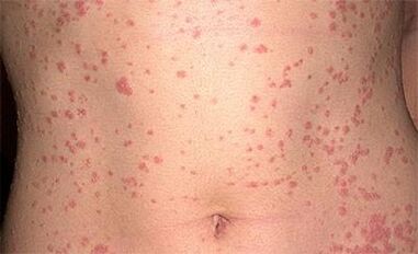 Psoriasis im Körper