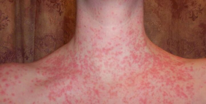 Psoriasis im Körper