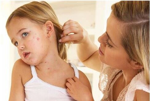 Foto der Anfangsphase der Psoriasis