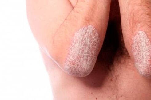 Psoriasis an den Ellenbogen