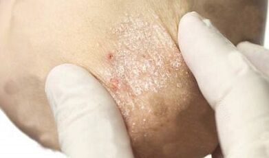 Behandlung von Psoriasis im Abschwächungsstadium