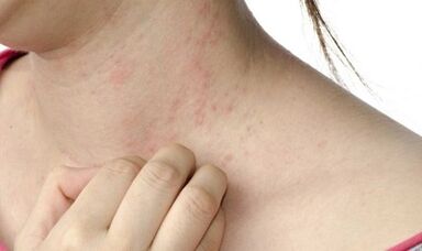 Behandlung von Psoriasis im fortgeschrittenen Stadium.