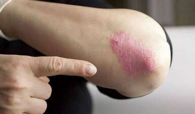 stationäres Stadium der Psoriasis-Entwicklung
