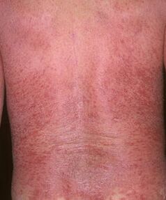 Erythrodermie