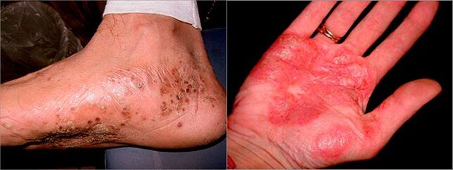 Palmoplantare Psoriasis