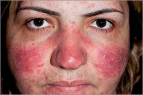 Seborrhoische Psoriasis