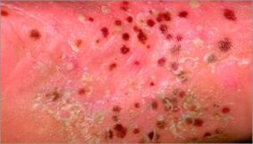 pustulöse Psoriasis