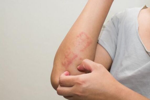 Die neuesten Methoden zur Behandlung von Psoriasis
