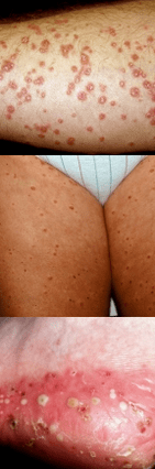 Beinpsoriasis